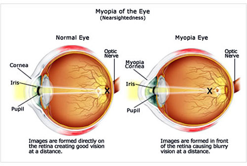 High Myopia